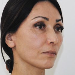 Eyebrow lift Before & After Patient #1585