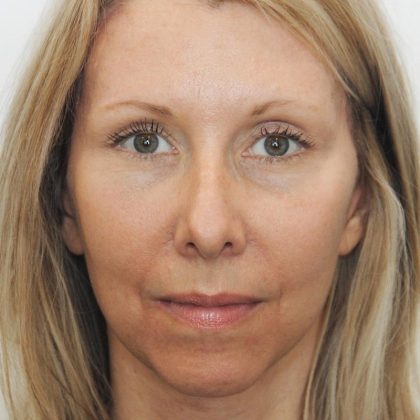 Eyebrow lift Before & After Patient #1586