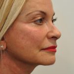 Eyebrow lift Before & After Patient #1587