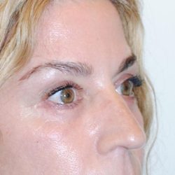 Eyebrow lift Before & After Patient #1590
