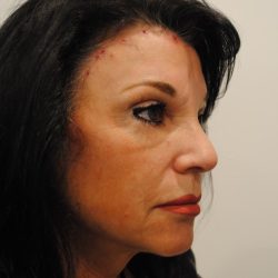 Eyebrow lift Before & After Patient #1592
