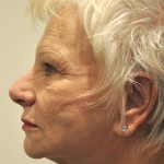 Eyebrow lift Before & After Patient #1593