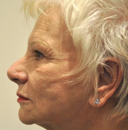Eyebrow lift Before & After Patient #1593