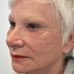 Eyebrow lift Before & After Patient #1593