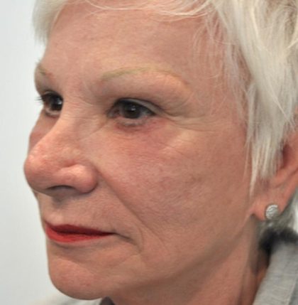 Eyebrow lift Before & After Patient #1593