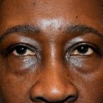 Blepharoplasty Before & After Patient #955