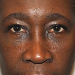 Blepharoplasty Before & After Patient #955