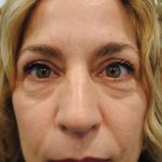 Blepharoplasty Before & After Patient #957