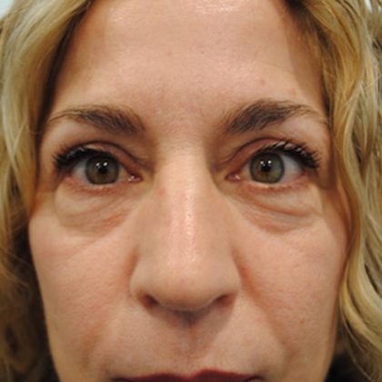 Blepharoplasty Before & After Patient #957