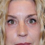 Blepharoplasty Before & After Patient #957