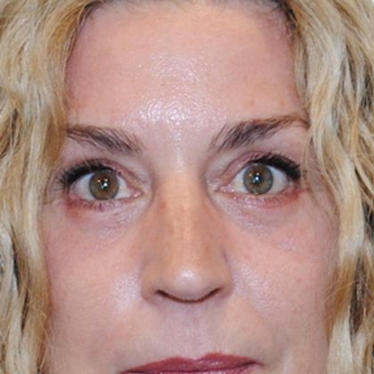 Blepharoplasty Before & After Patient #957