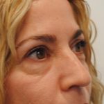 Blepharoplasty Before & After Patient #957