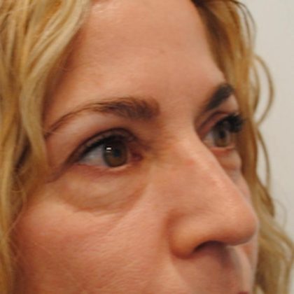 Blepharoplasty Before & After Patient #957