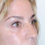 Blepharoplasty Before & After Patient #957