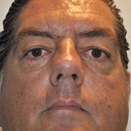 Blepharoplasty Before & After Patient #958