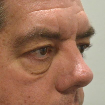 Blepharoplasty Before & After Patient #958