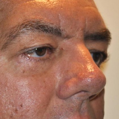 Blepharoplasty Before & After Patient #958