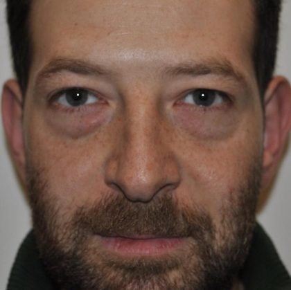 Blepharoplasty Before & After Patient #959