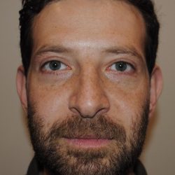 Blepharoplasty Before & After Patient #959