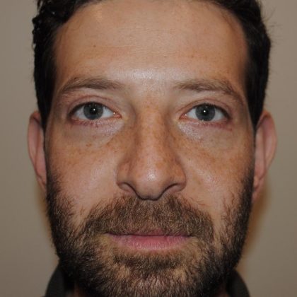 Blepharoplasty Before & After Patient #959