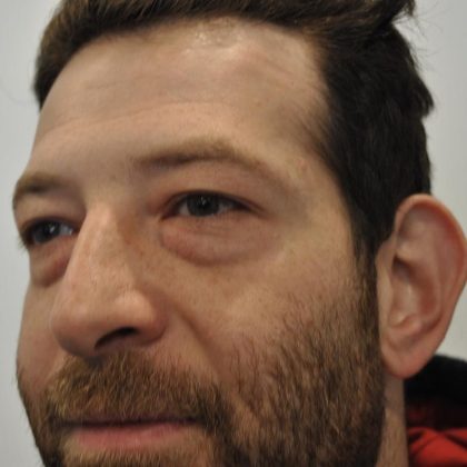 Blepharoplasty Before & After Patient #959