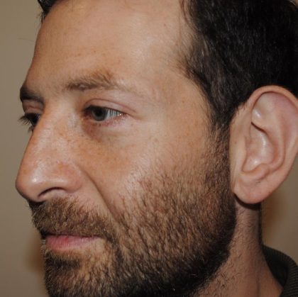 Blepharoplasty Before & After Patient #959