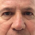 Blepharoplasty Before & After Patient #960