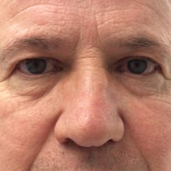 Blepharoplasty Before & After Patient #960