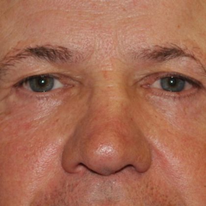 Blepharoplasty Before & After Patient #960