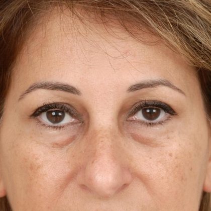 Blepharoplasty Before & After Patient #961