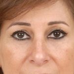 Blepharoplasty Before & After Patient #961