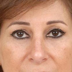 Blepharoplasty Before & After Patient #961