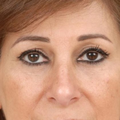 Blepharoplasty Before & After Patient #961