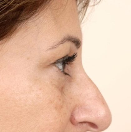 Blepharoplasty Before & After Patient #961