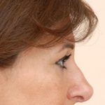Blepharoplasty Before & After Patient #961