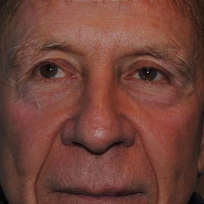 Blepharoplasty Before & After Patient #963