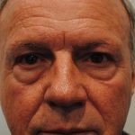 Blepharoplasty Before & After Patient #964