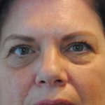 Blepharoplasty Before & After Patient #965