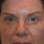 Blepharoplasty Before & After Patient #965