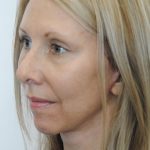 Face And Neck Lift Before & After Patient #1002