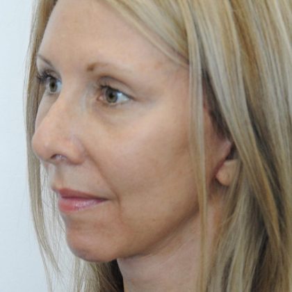 Face And Neck Lift Before & After Patient #1002