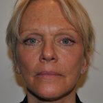 Face And Neck Lift Before & After Patient #1003