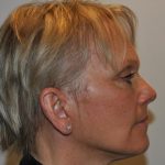 Face And Neck Lift Before & After Patient #1003