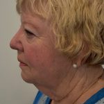 Face And Neck Lift Before & After Patient #1005