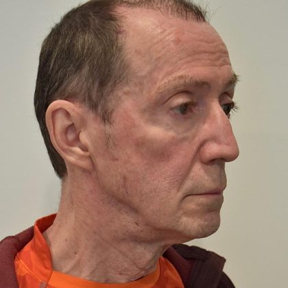 Face And Neck Lift Before & After Patient #1006