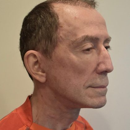Face And Neck Lift Before & After Patient #1006