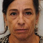 Face And Neck Lift Before & After Patient #1007