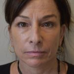 Face And Neck Lift Before & After Patient #1007