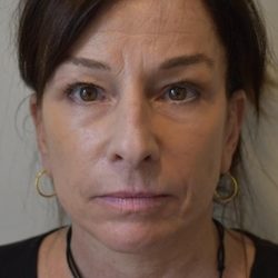 Face And Neck Lift Before & After Patient #1007