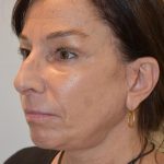 Face And Neck Lift Before & After Patient #1007